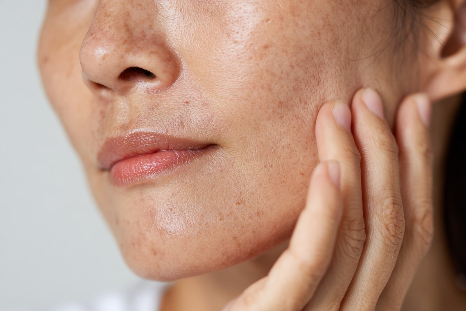 Woman with uneven pigment across her cheek resting a hand against her face
