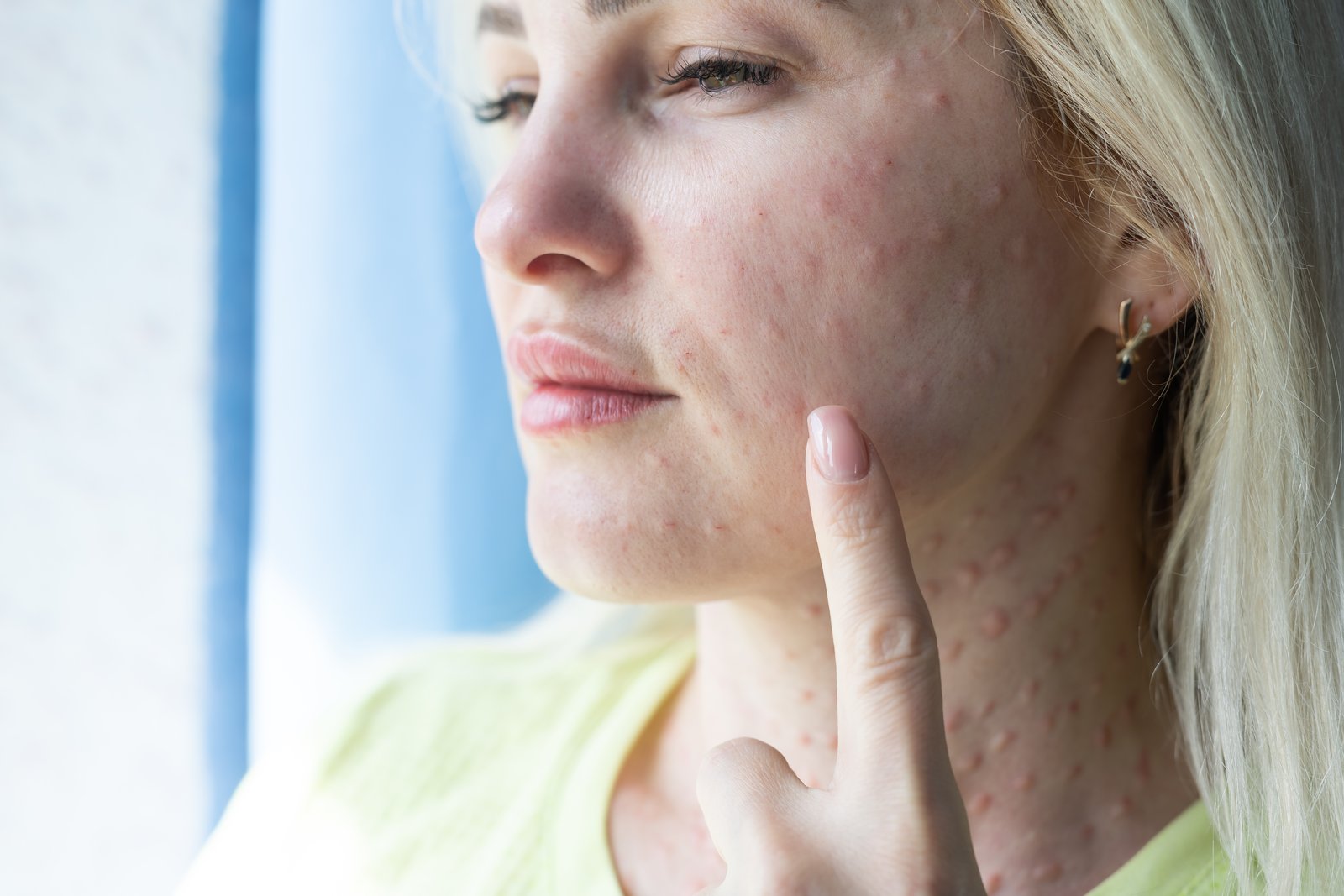 Close-up of a young woman's cheek with acne