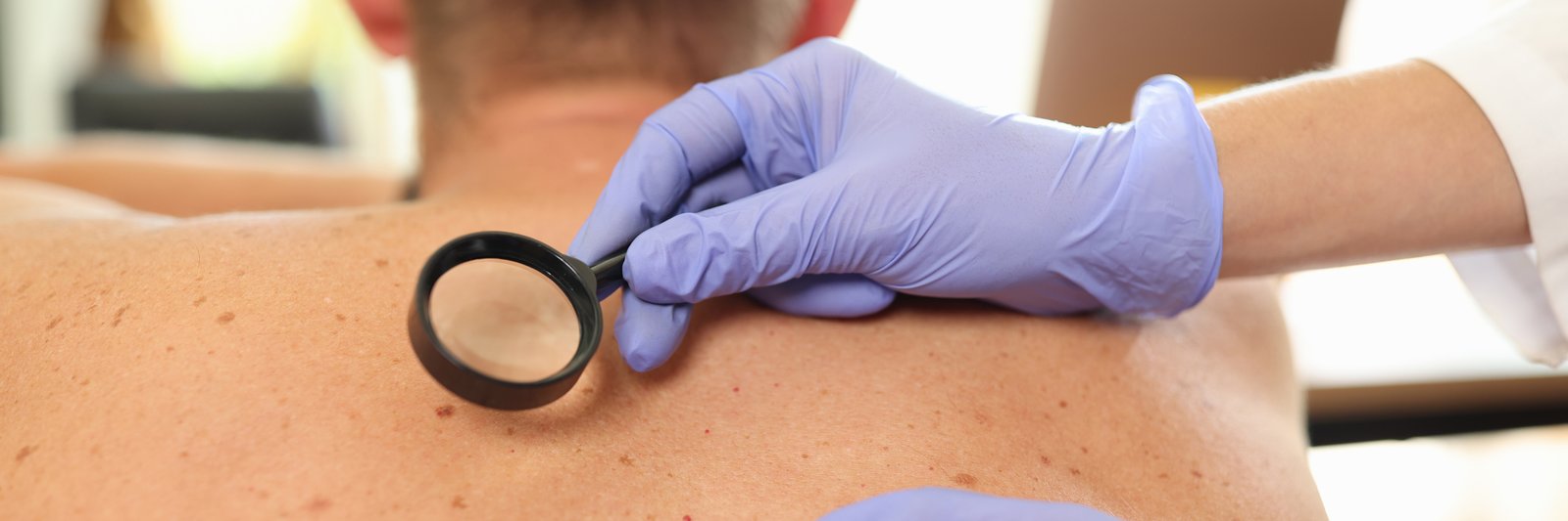 Gloved hand holding a magnifier over a mark on a patient's upper back