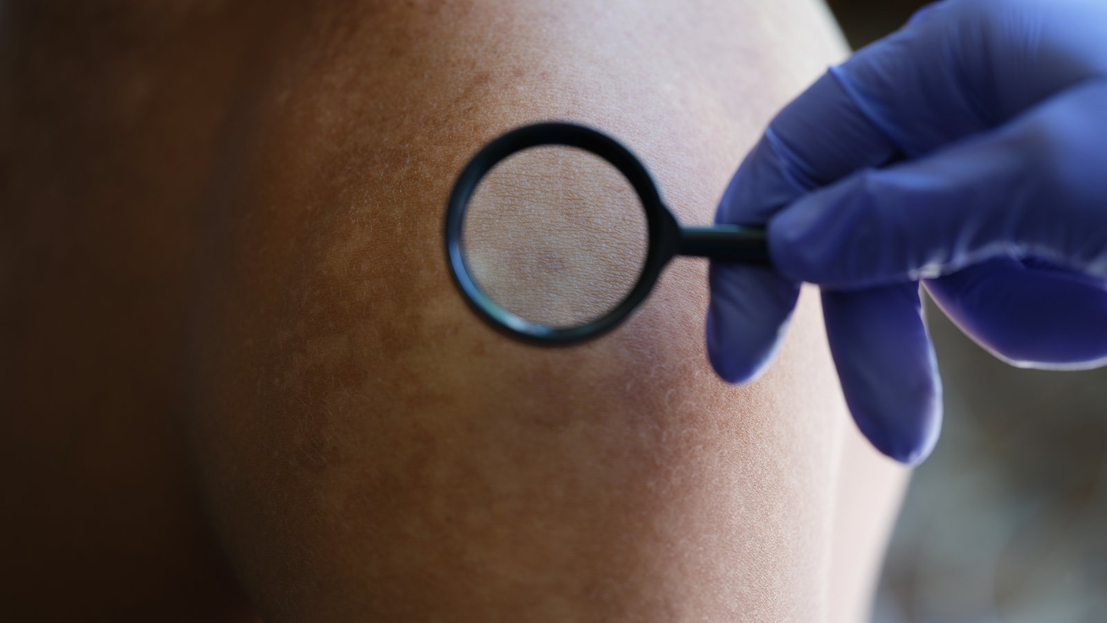 Gloved hand holding a magnifier over an area of skin during a dermatology exam