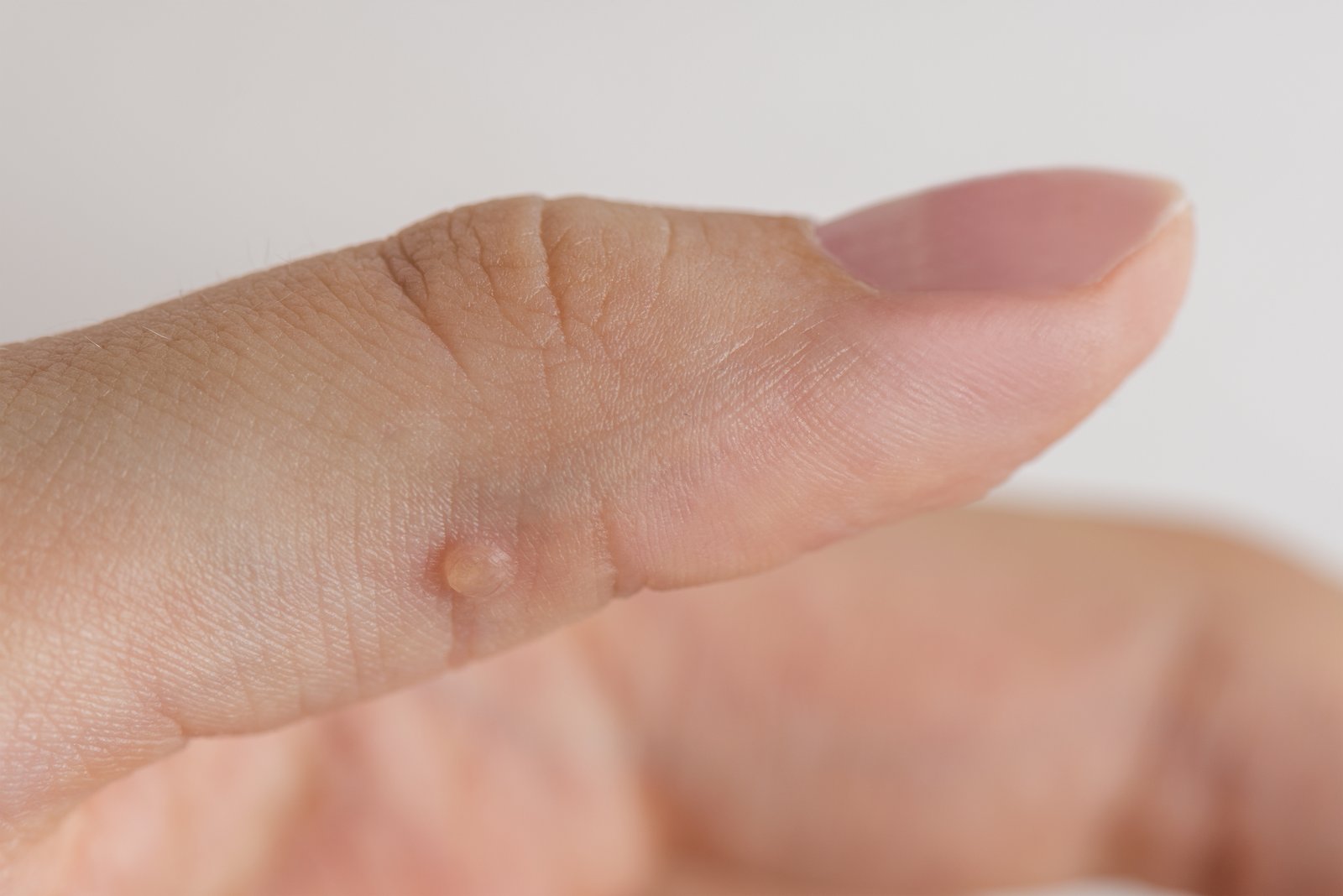 Close-up of a small raised wart on a finger
