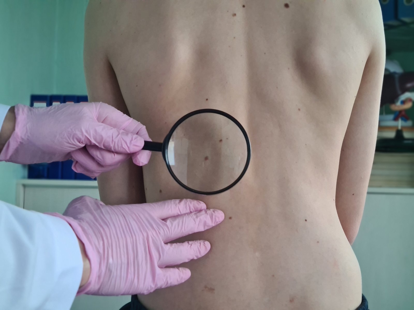 Gloved hands holding a magnifier over moles on a patient's lower back