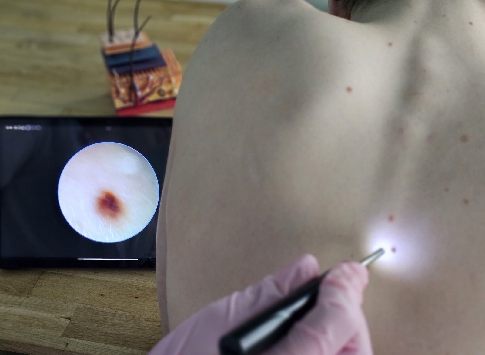 Clinician guiding a video dermatoscope across a patient's back, the skin magnified on a screen