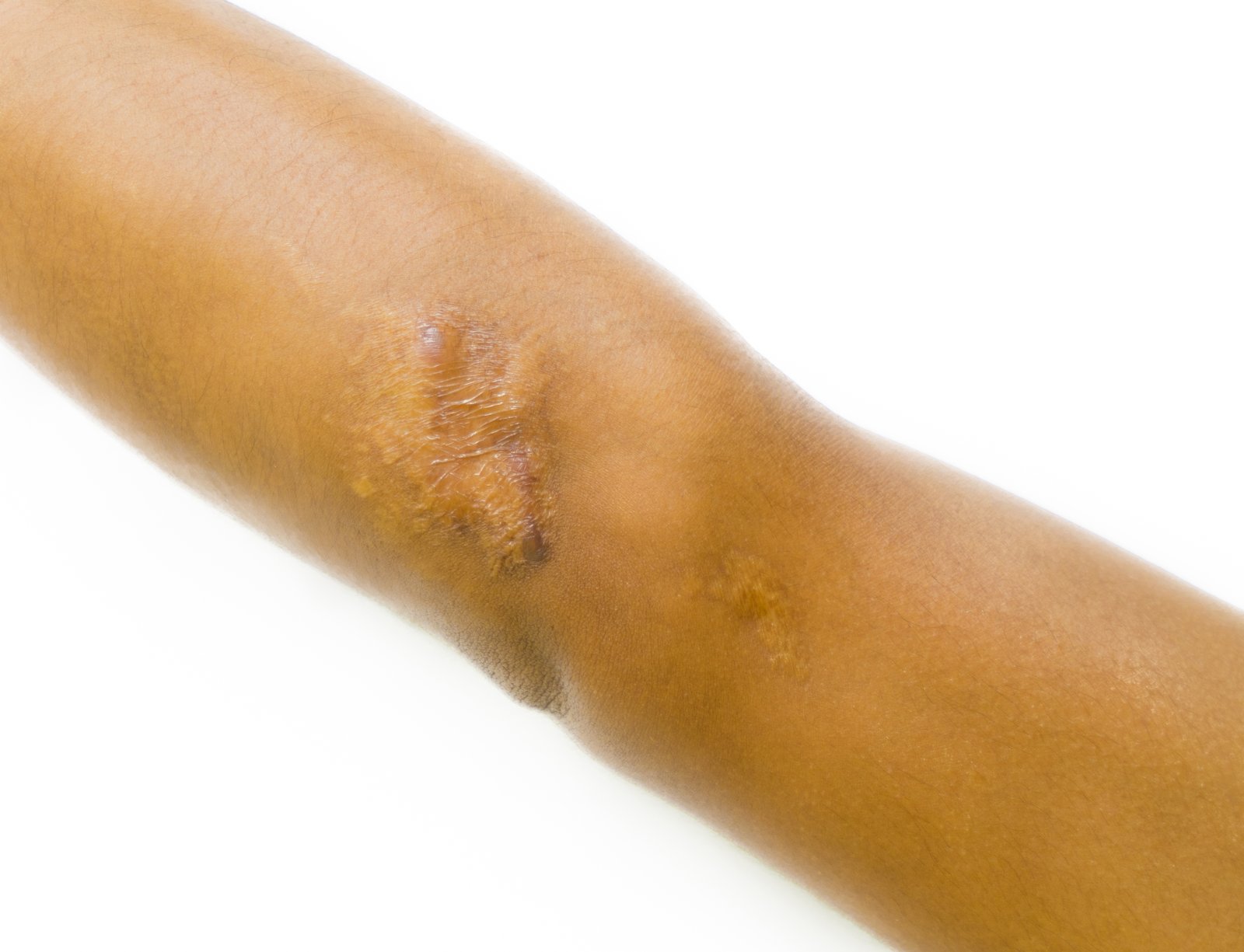 Close-up of a raised keloid scar on a forearm