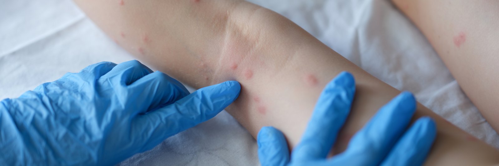 Gloved hands examining a red rash on a child's leg