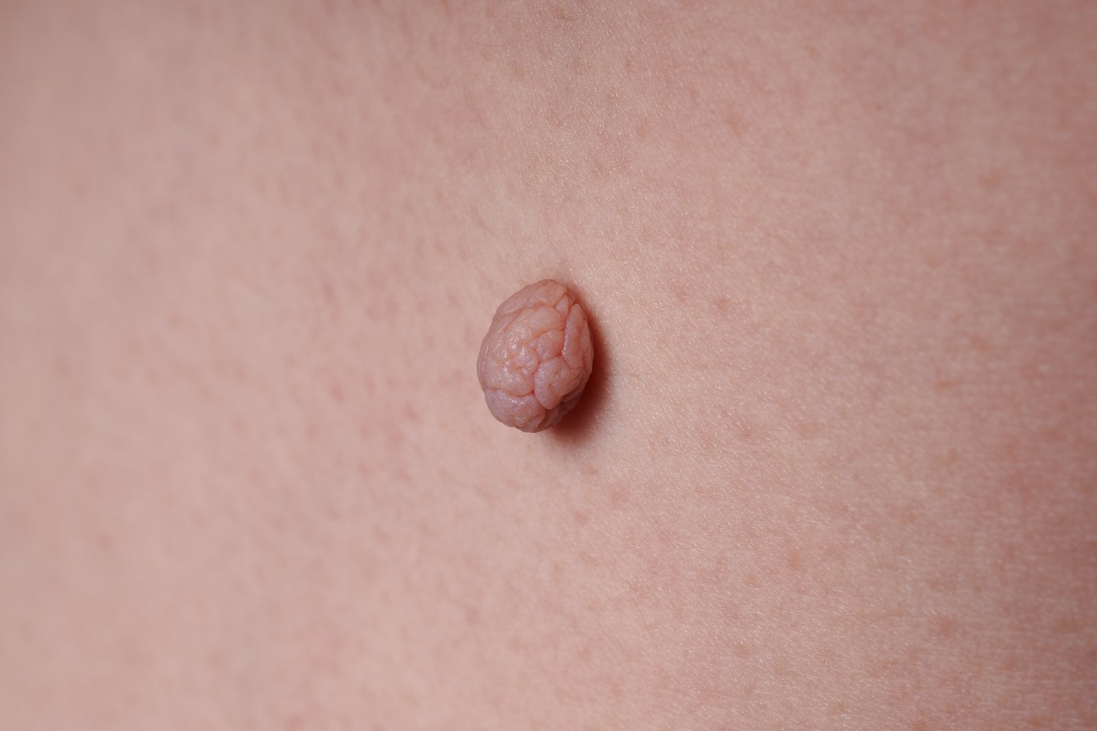 Close-up of a small raised skin tag on pale skin