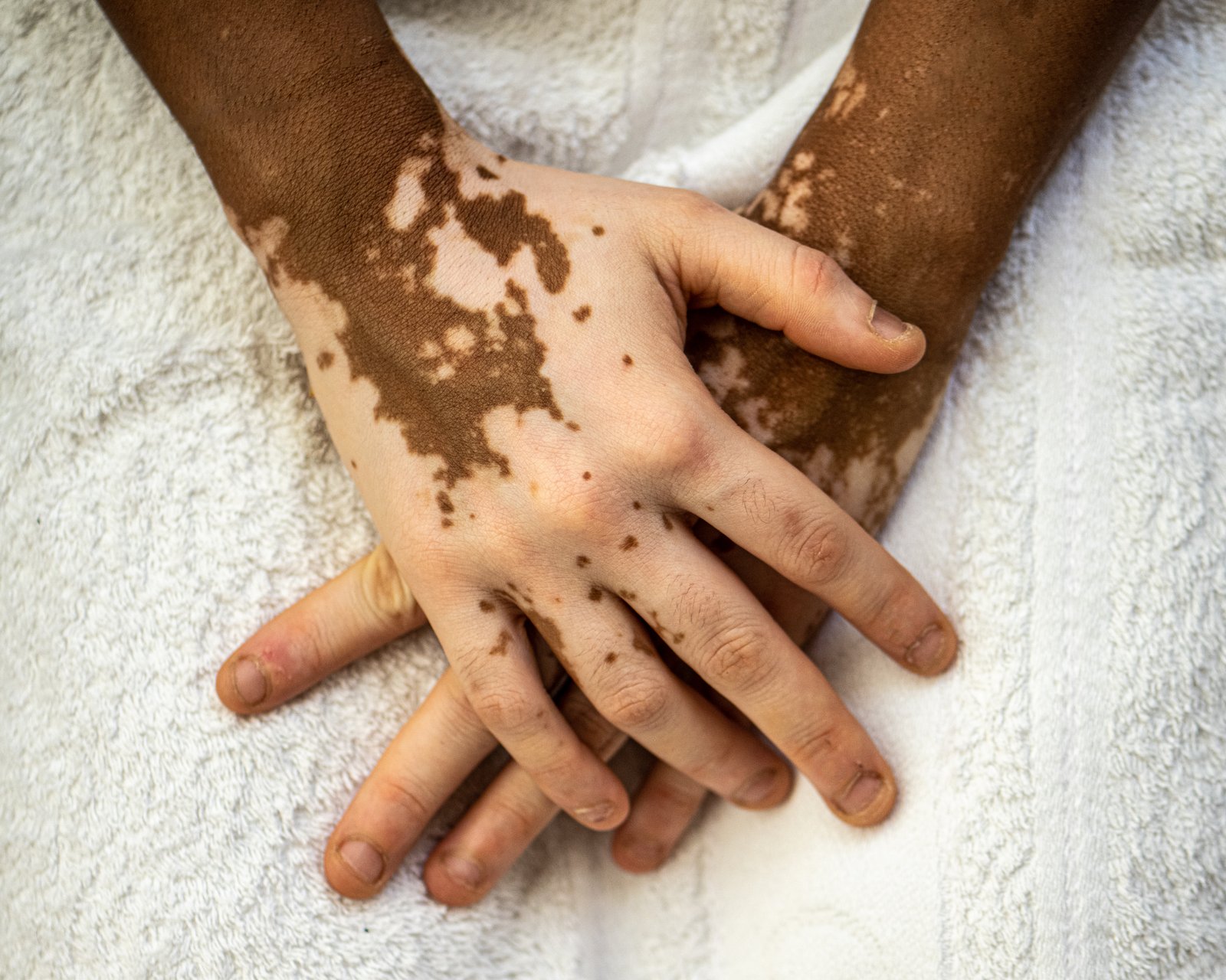 Hands with pale vitiligo patches resting on a white towel