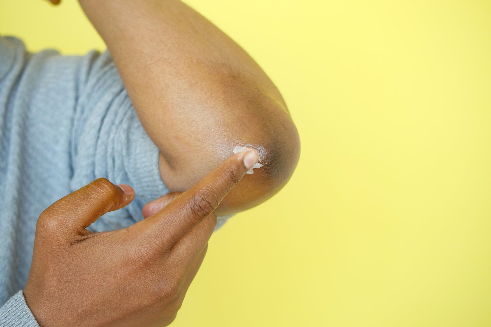 Fingers applying cream to dry skin at the elbow