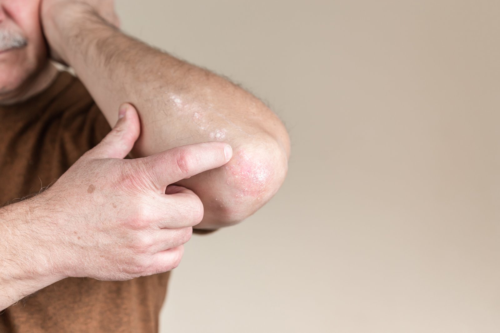 Man touching a scaly patch of skin on his elbow