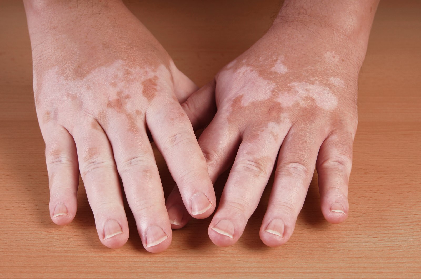 Two hands with white vitiligo patches resting on a wooden surface