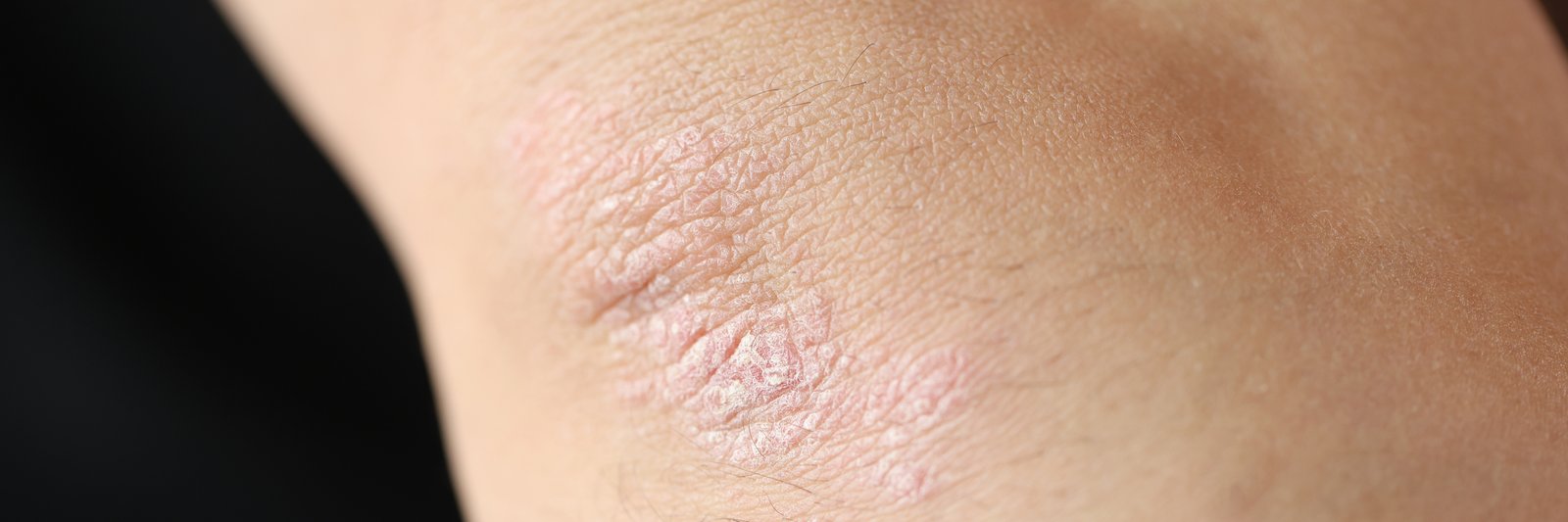 Close-up of a raised scaly plaque on skin
