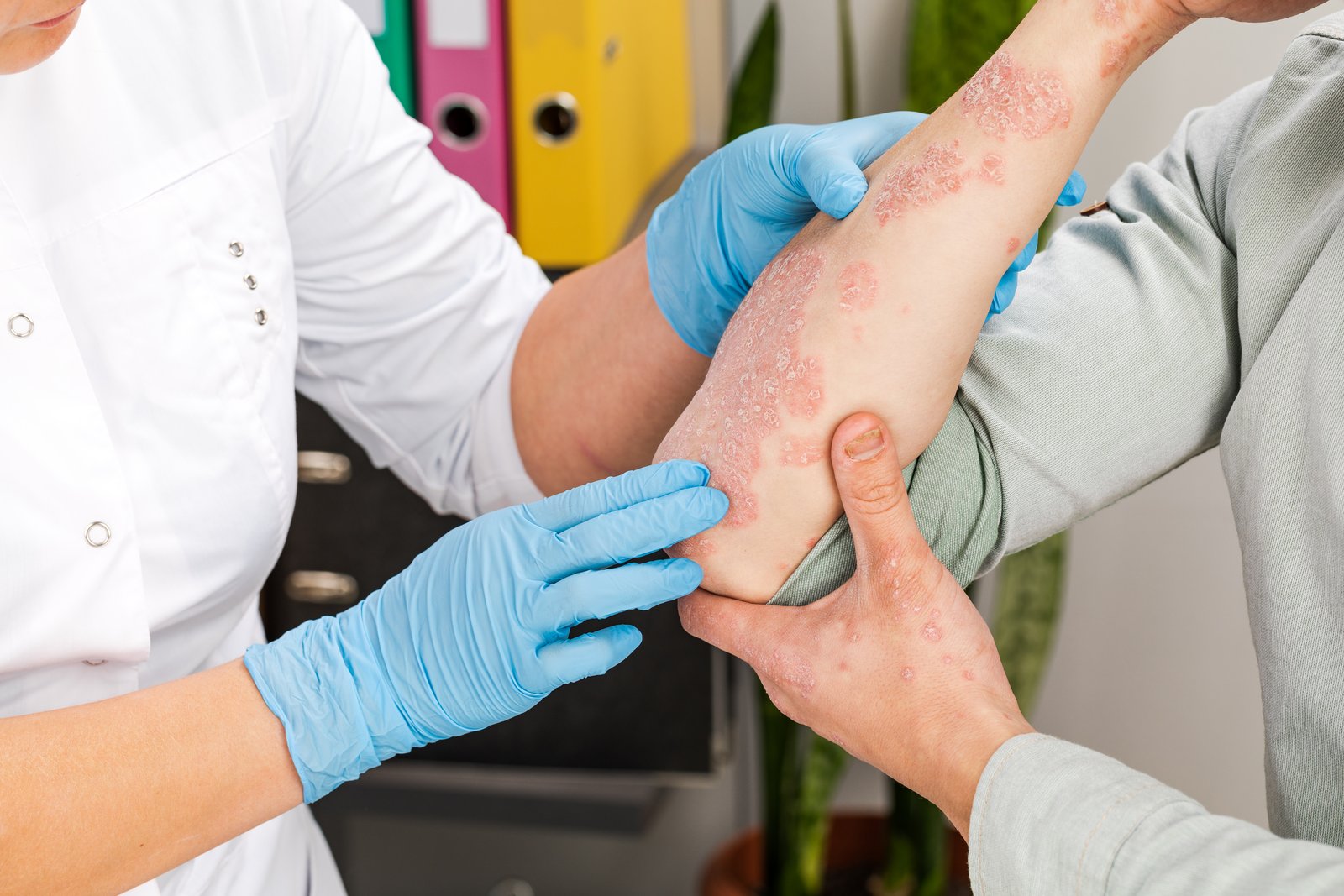 Gloved dermatologist examining scaly patches on a patient's forearm
