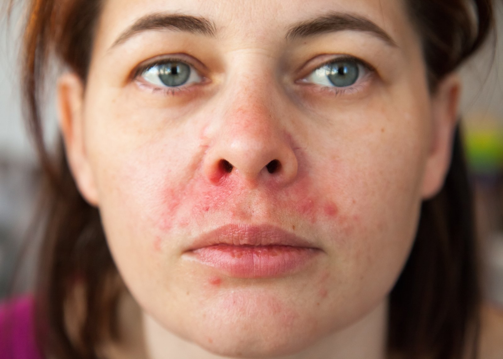 Close-up of a woman's face showing redness across the cheeks and chin