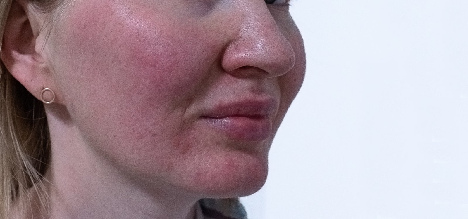 Close-up of a woman's cheek and jaw showing diffuse facial redness