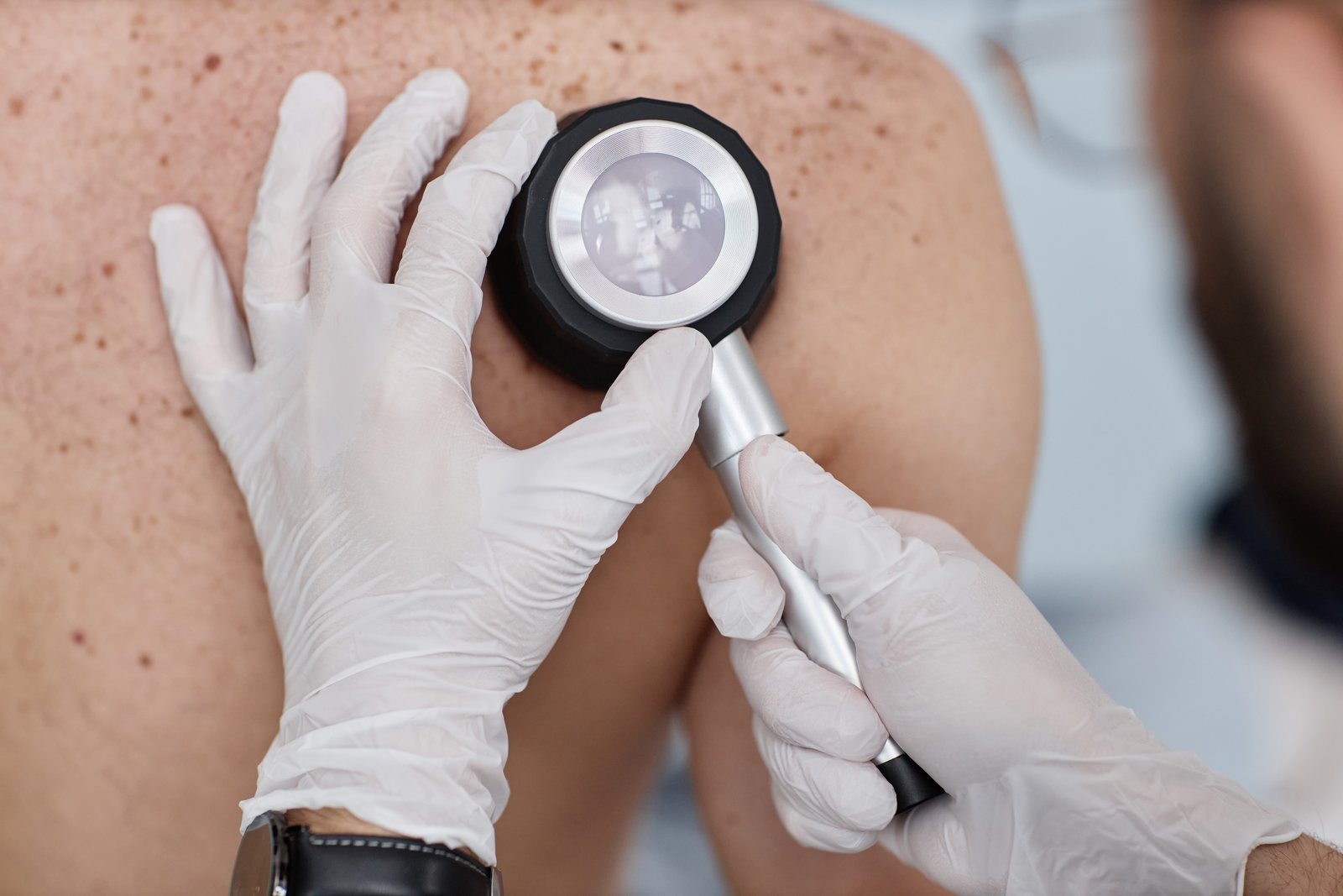 Gloved hands holding a lit dermatoscope against a patient's shoulder