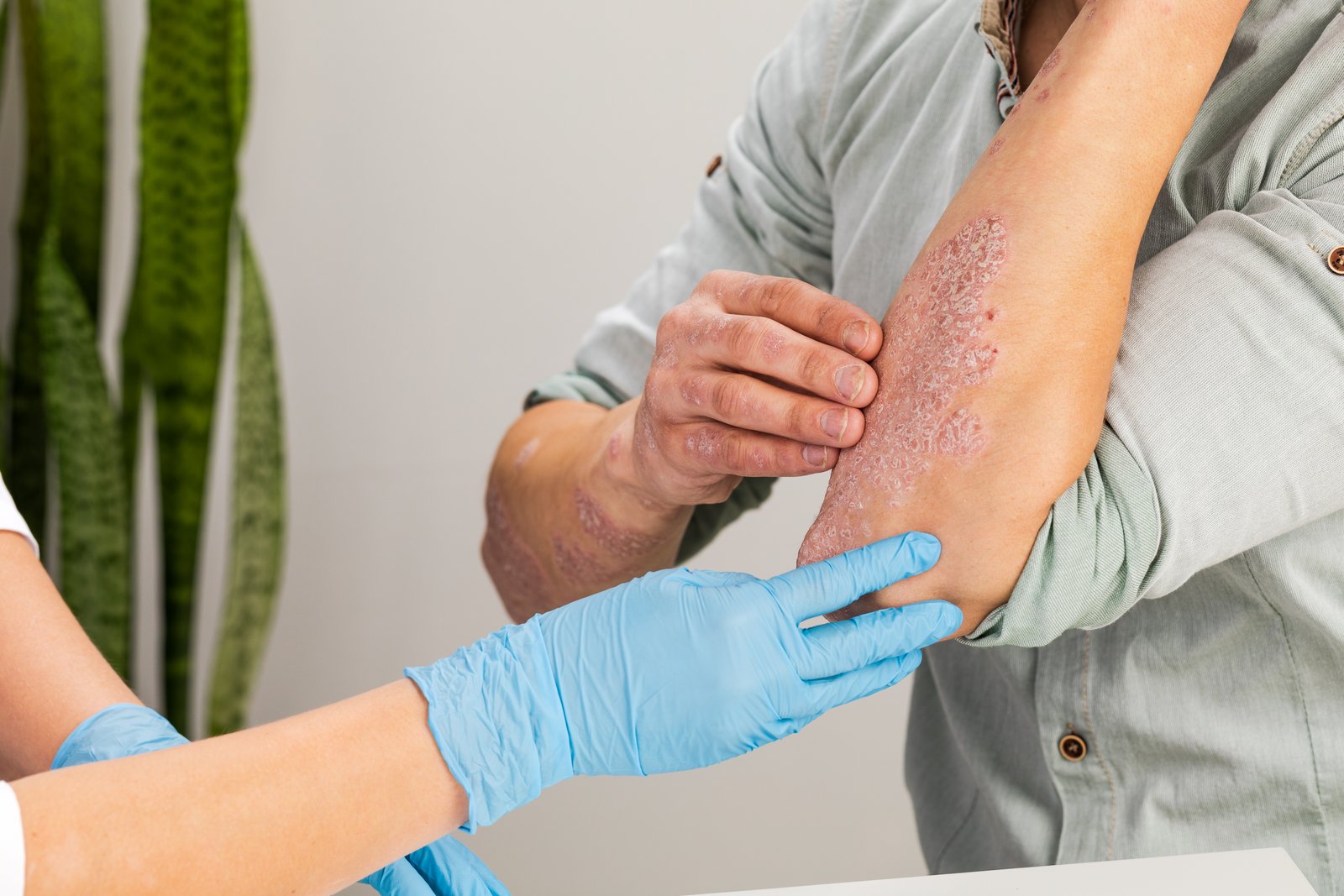 Gloved hand examining a scaly patch on a patient's forearm