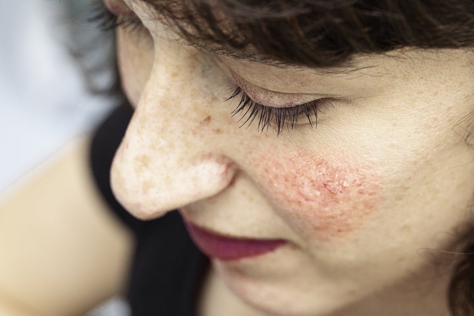 Close-up of a woman's cheek with redness and small red bumps