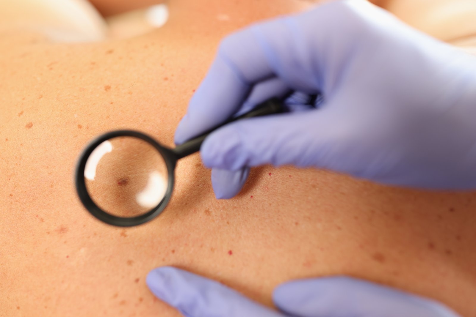 Gloved hands holding a round magnifier over a growth on a patient's back