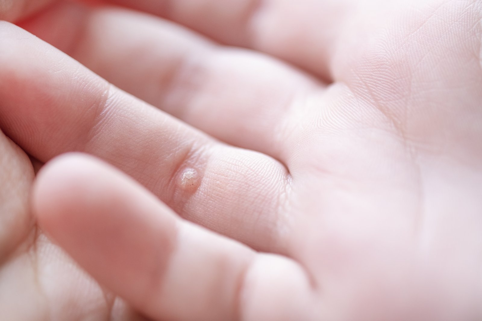 Close-up of a child's hand with small warts on the fingers