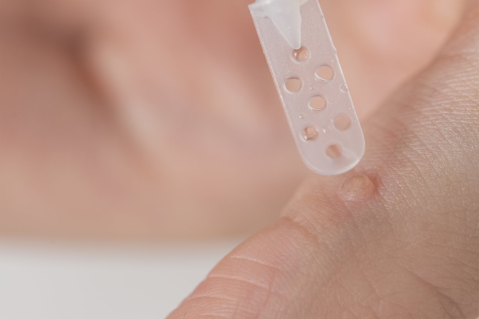 Wart on a hand being treated with medication applied on a small spatula