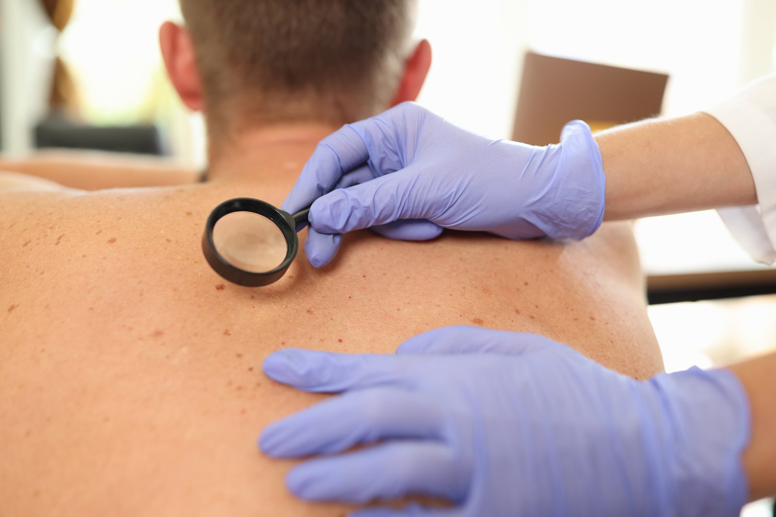Dermatologist examining a mark on a patient's shoulder blade with a magnifier