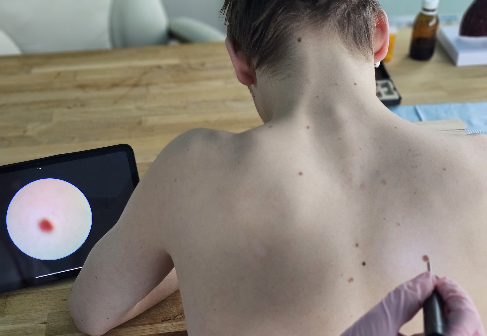 Video dermatoscope passing over a patient's upper back with the image shown on a monitor