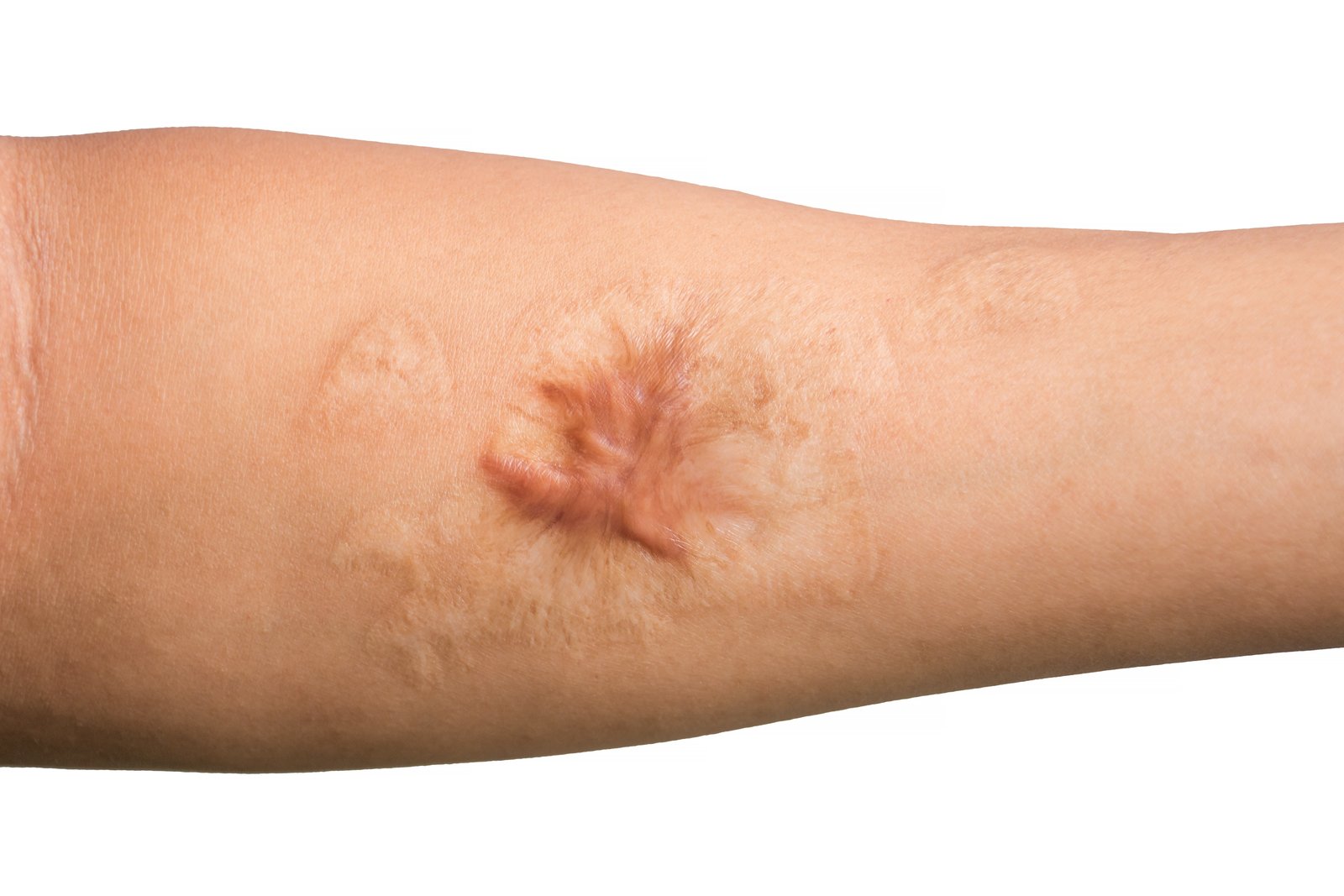 Close-up of a raised starburst-shaped scar on a forearm