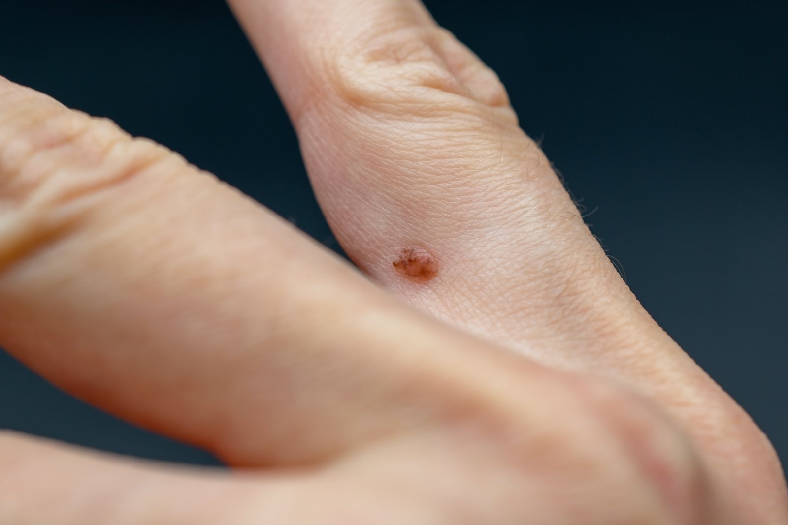 Close-up of a flat wart on the back of a hand