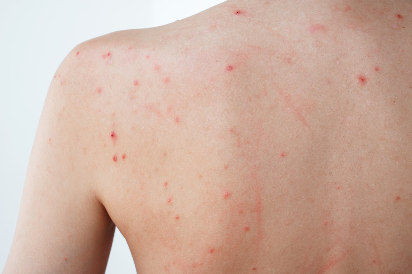 Close-up of a person's upper back and shoulders with scattered red acne spots