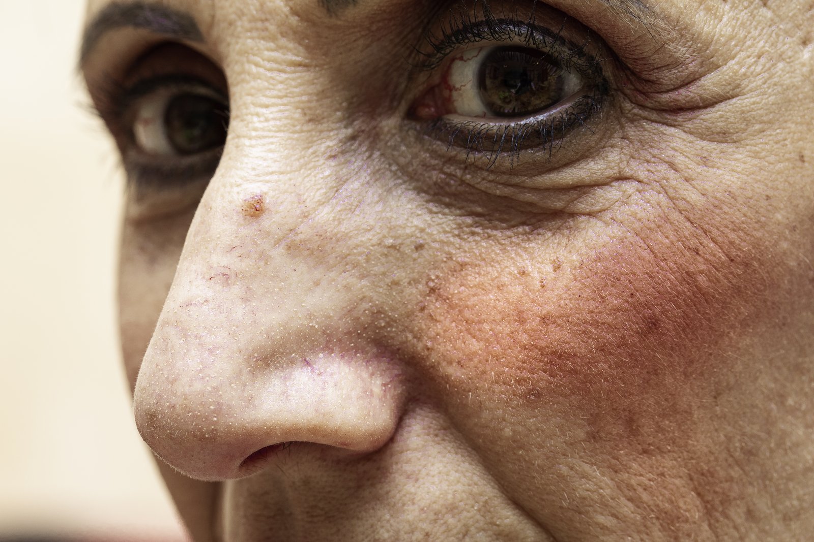 Close-up of a mature woman's cheek and nose showing redness and visible small blood vessels